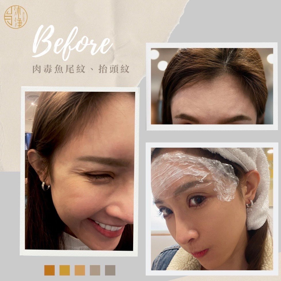 肉毒小臉案例分享